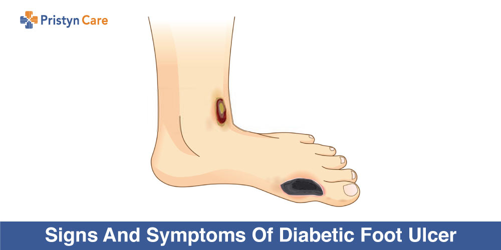 diabetic foot early symptoms