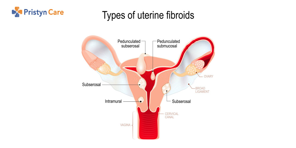 types of uterine fibroids