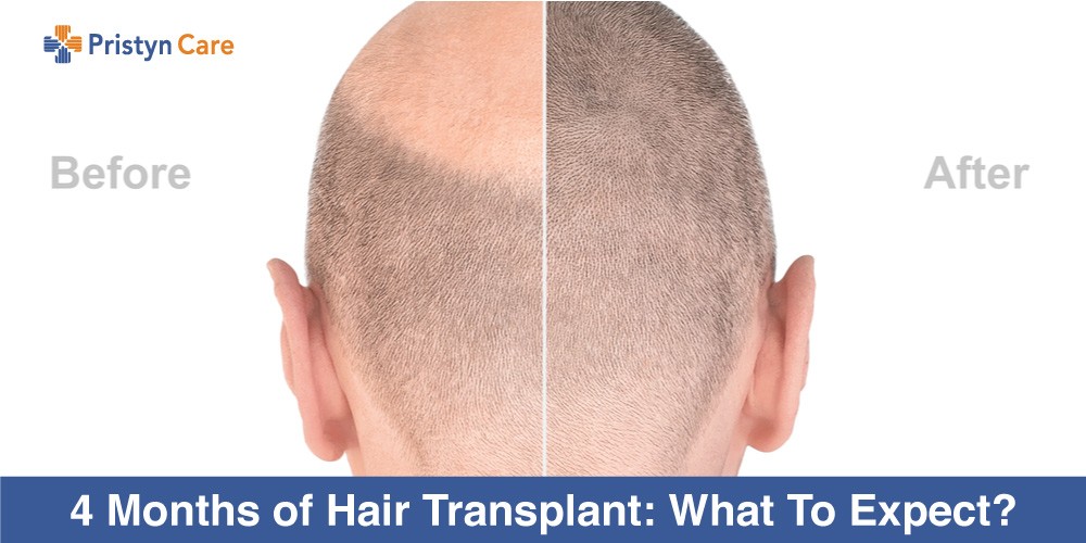Record breaking hair transplant surgery  6 months have passed
