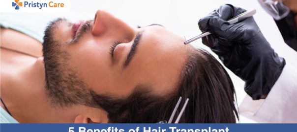 5 Benefits of Hair Transplant