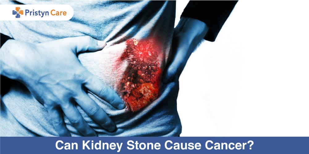 Can Kidney Stones Cause Cancer 