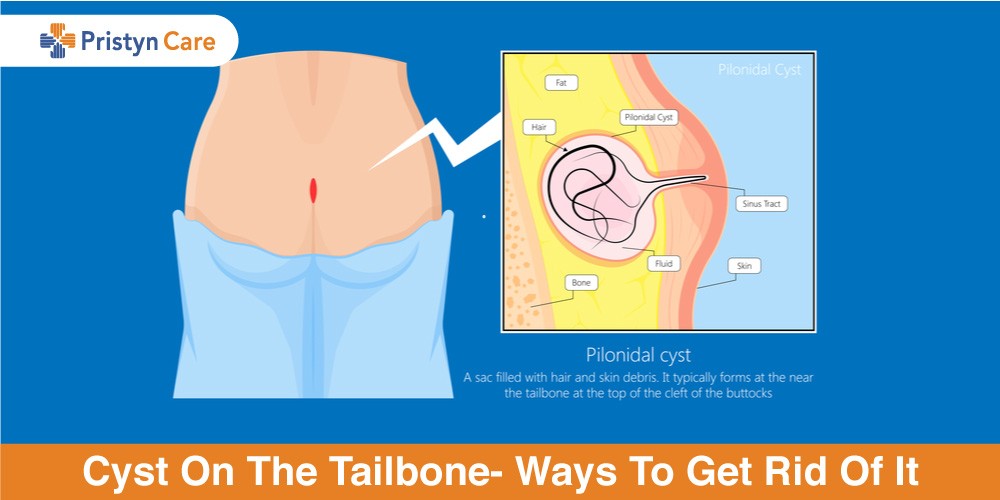 Find a Clinician who will TOUCH your Coccyx if you have Tailbone