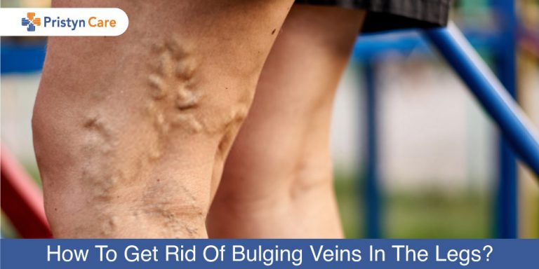 Bulging Veins In Legs After Walking