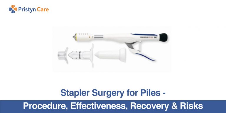 Stapler Surgery for Piles - Procedure, Effectiveness, Recovery and Risks