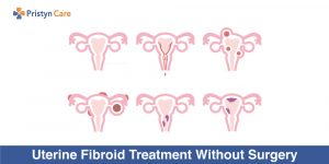 Uterine Fibroid Treatment Without Surgery