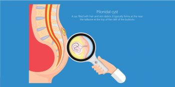 Living With Pilonidal Sinus- Things To Take Care Of - Pristyn Care