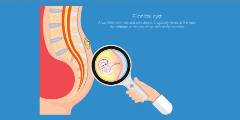 Pilonidal Cyst Diagram