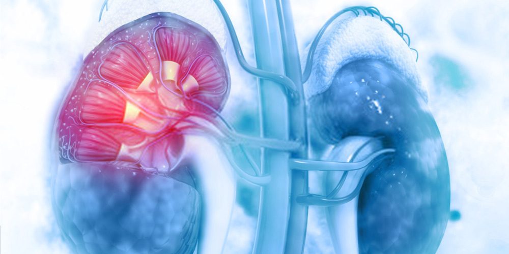 Is Laser Treatment Safe For Kidney Stones 