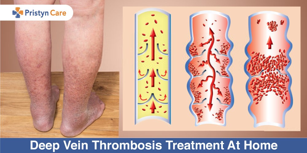 Deep Vein Thrombosis Treatment At Home - Pristyn Care