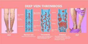 Thrombectomy For DVT - Pristyn Care