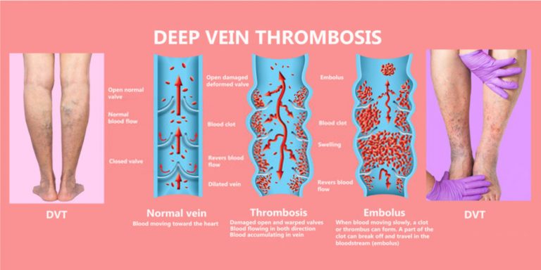 Thrombectomy For DVT - Pristyn Care