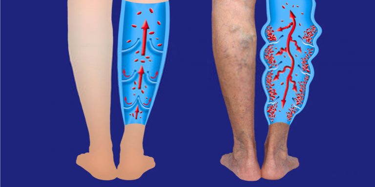 Lower Leg Pain and Swelling - Causes and Treatment - Pristyn Care