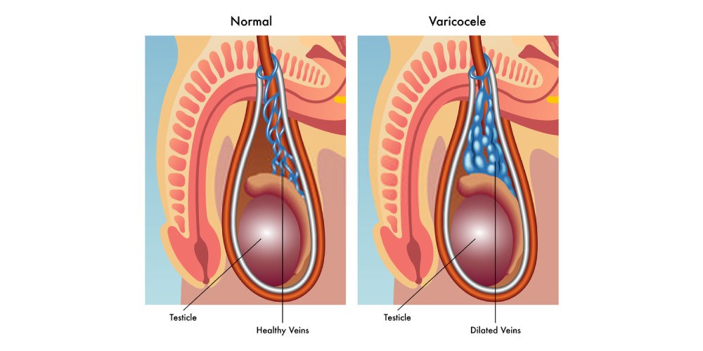 normal testes and testes affected with varicocele