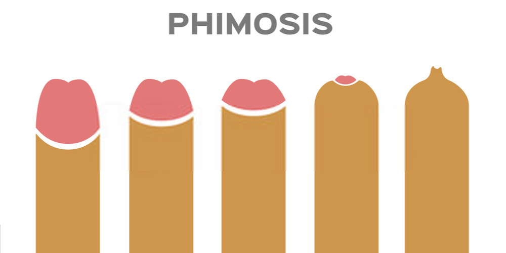 Cure Phimosis Without Surgery