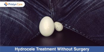 Hydrocele Treatment Without Surgery