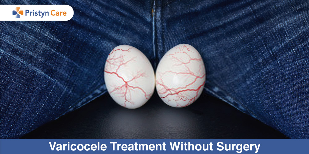 Varicocele Treatment Without Surgery - Bharat Homeopathy