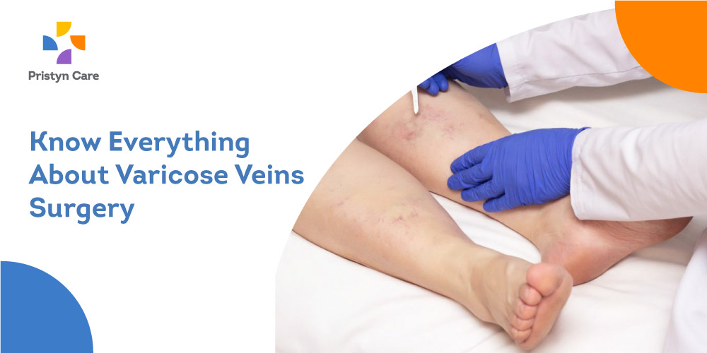 Know Everything About Varicose Veins Surgery - Pristyn Care