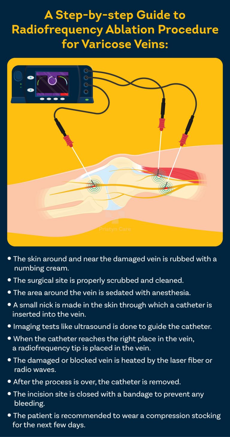 Radiofrequency Ablation Rfa For Varicose Veins Procedure Effectiveness And Cost Pristyn Care