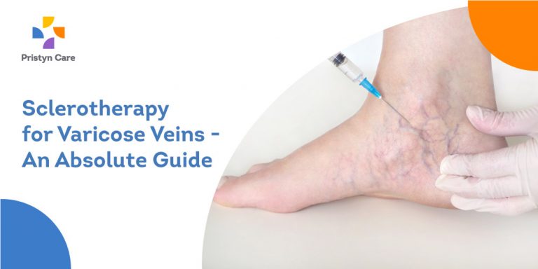 How Physiotherapy Helps in Treating Varicose Veins? - Pristyn Care