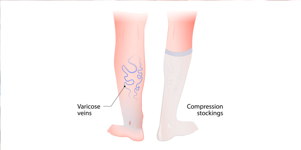 Compression Stockings for Varicose Veins: Which Type Is Best for You?