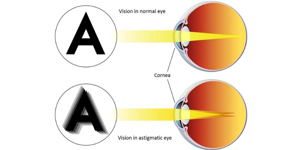 Astigmatism Types, Symptoms, Causes, Risks, Diagnosis, and Treatment