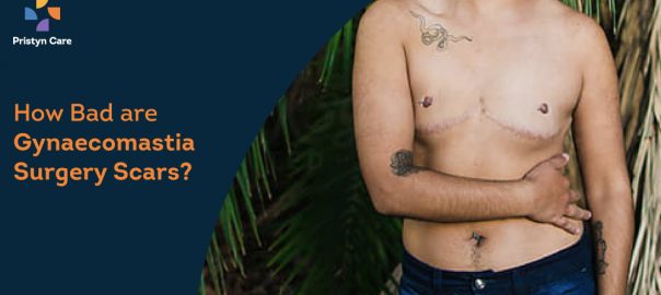 How Bad are Gynaecomastia Surgery Scars?