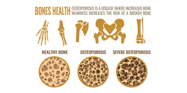 What Is The Difference Between Osteoporosis And Osteoarthritis ...