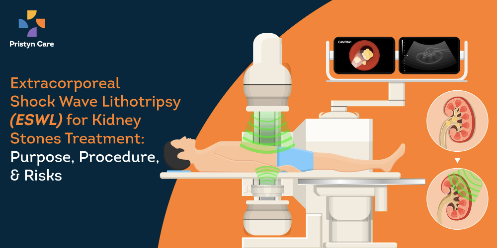 extracorporeal-shock-wave-lithotripsy-eswl-purpose-procedure-and