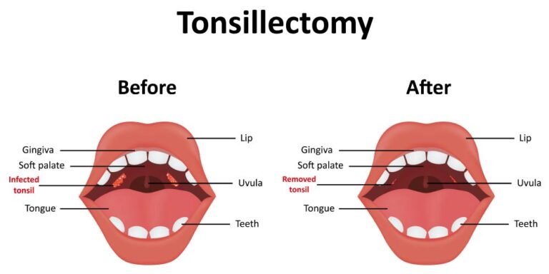 A Complete Guide to Tonsillectomy - Pristyn Care