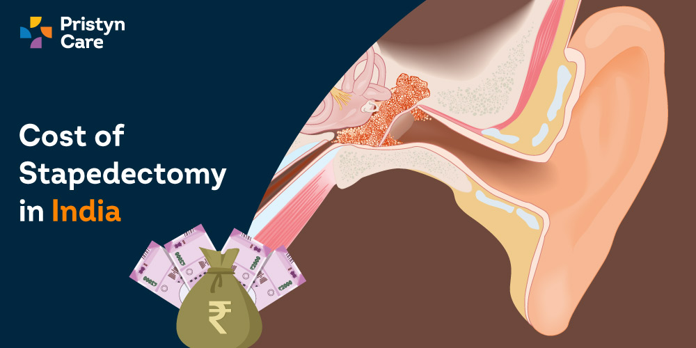 Cost-of-stapedectomy-in-India