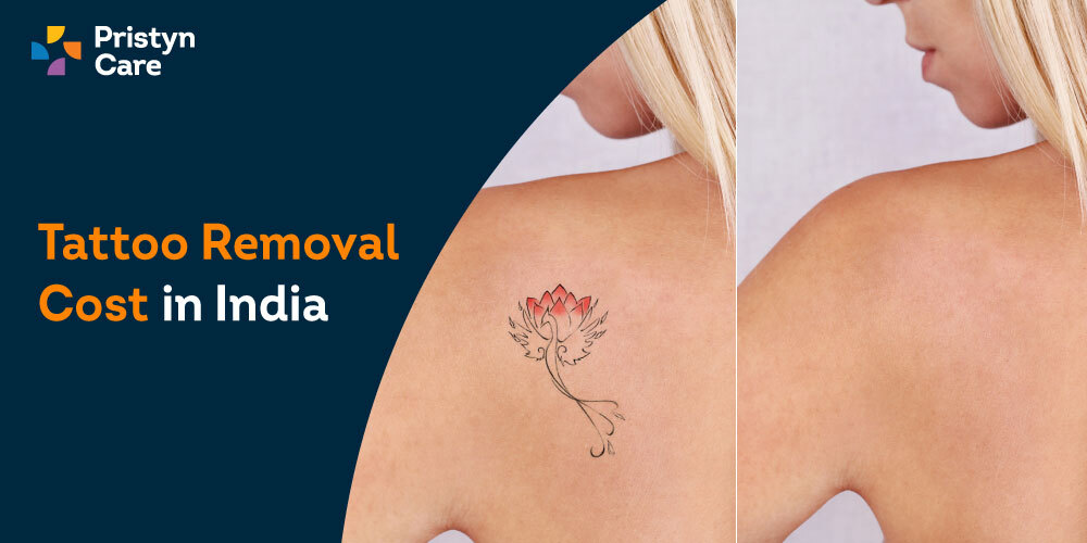 Laser Tattoo Removal Results Gallery | EradiTatt
