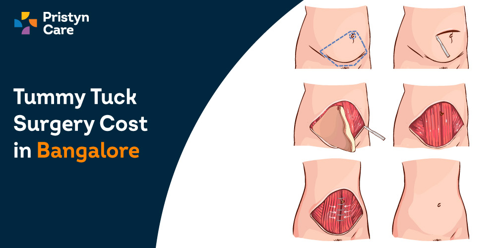 Tummy Tuck Surgery Cost in Bangalore