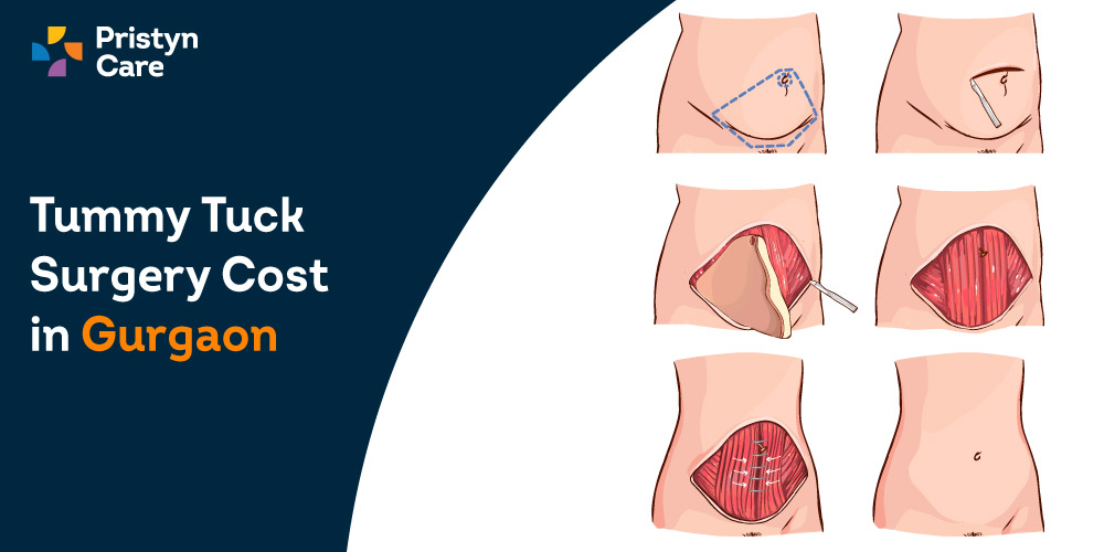 Tummy-Tuck-Surgery-Cost-in-Gurgaon