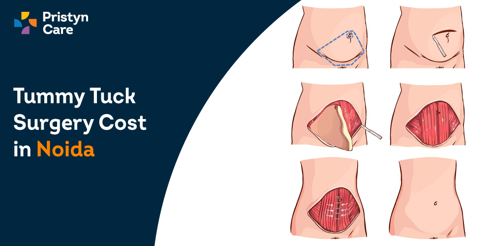 Tummy Tuck Surgery in Kurukshetra, Abdominoplasty in Kurukshetra