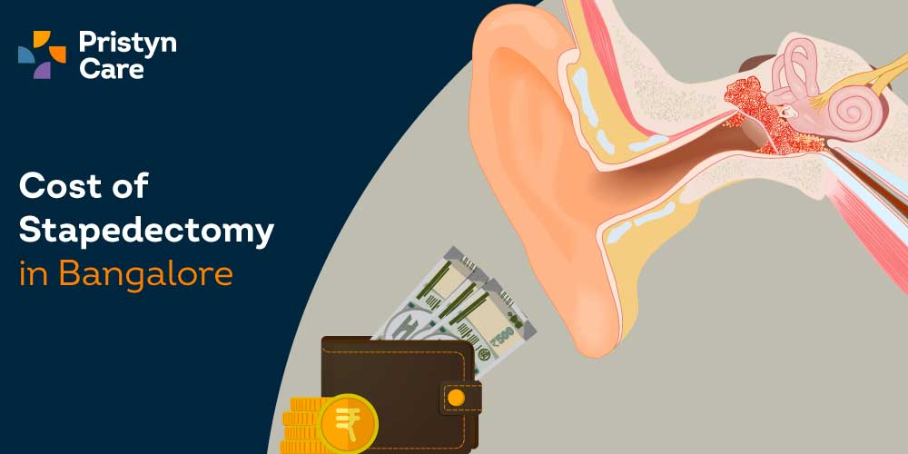 Cost of stapedectomy in Bangalore