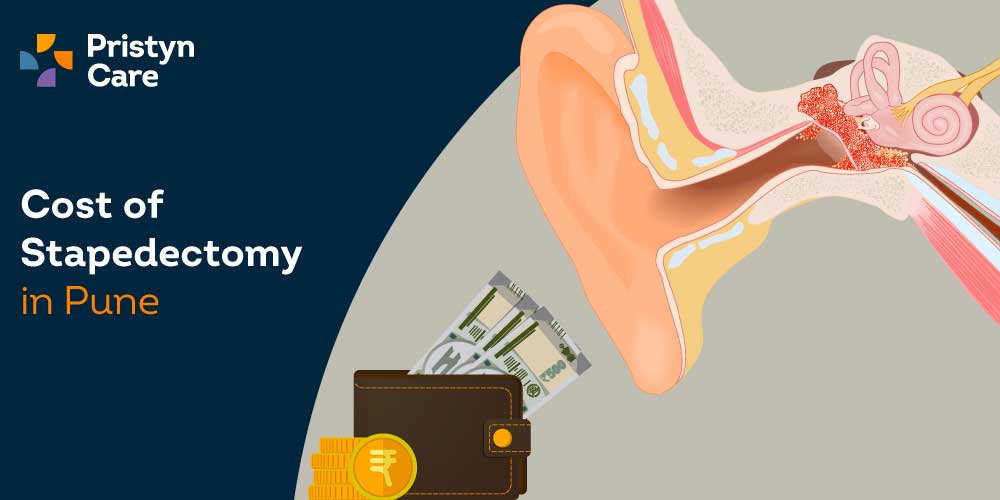 Cost-of-stapedectomy-in-Pune