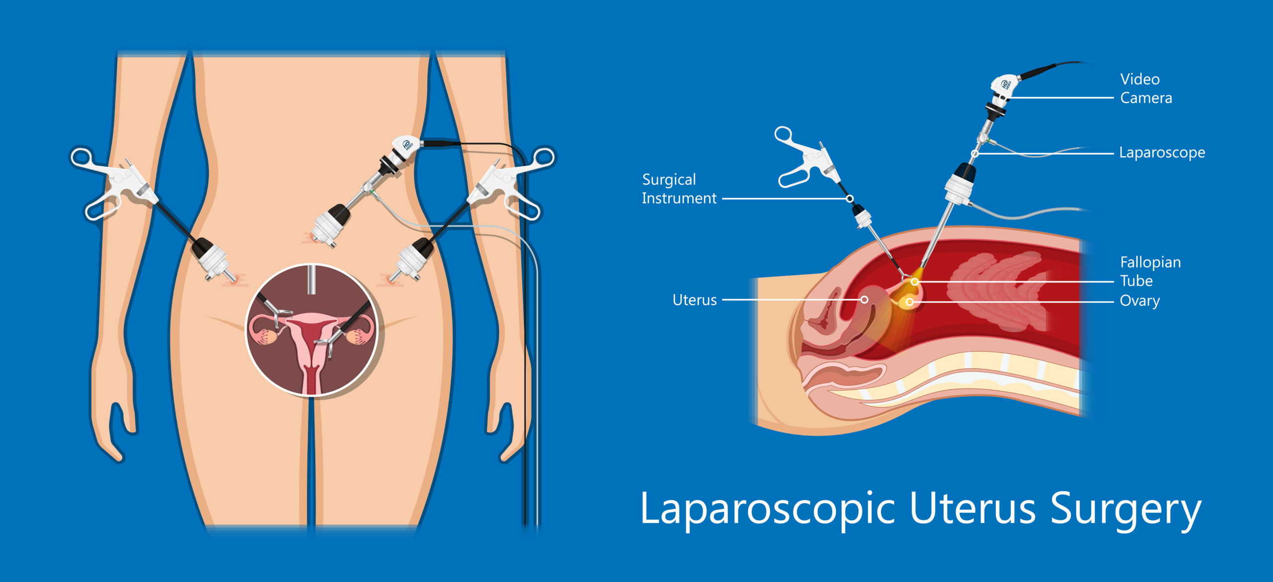 Laparoscopic Uterus Surgery