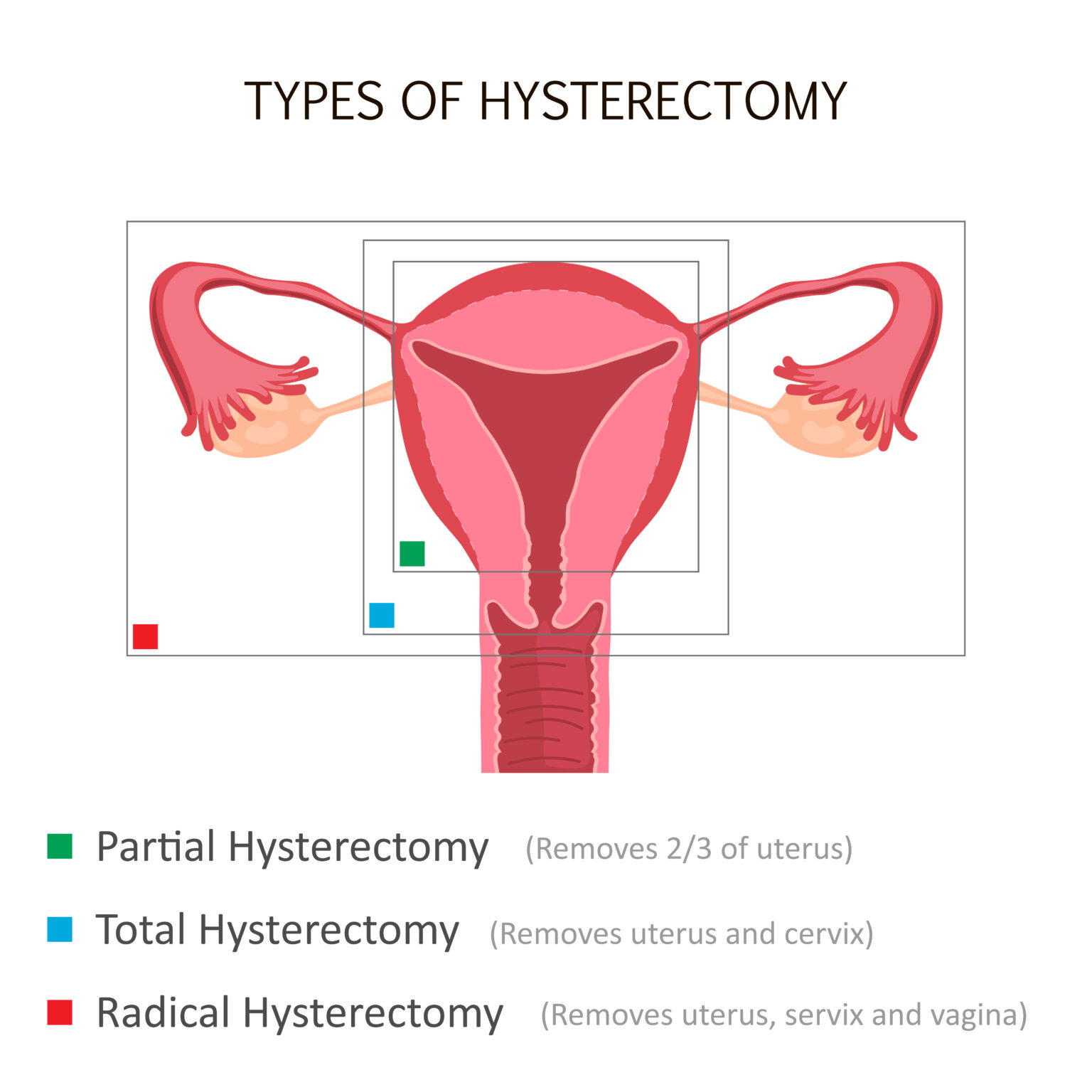 What You Need To Know About Hysterectomy Uterus Removal Surgery Pristyn Care 