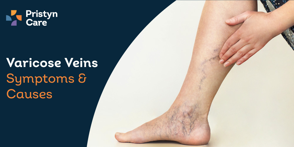 Varicose Veins Symptoms and Causes - Pristyn Care