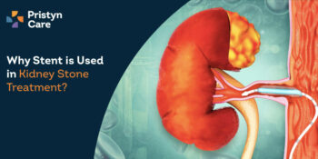 Why Stent is Used in Kidney Stone Treatment? - Pristyn Care