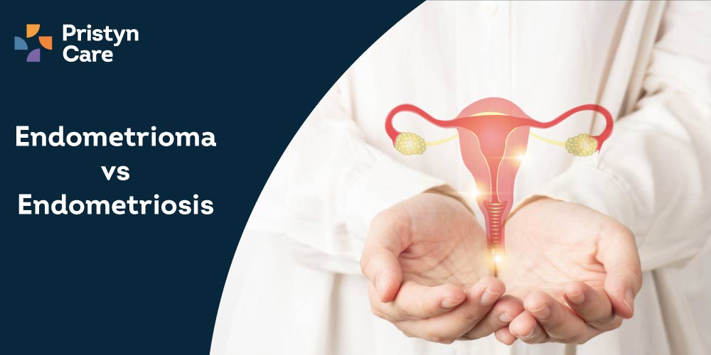 Endometrioma vs Endometriosis