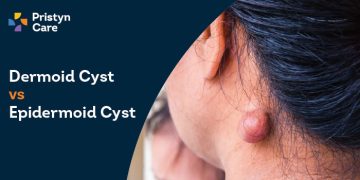 Dermoid Cyst vs Epidermoid Cyst