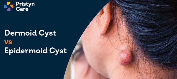 Dermoid Cyst vs Epidermoid Cyst