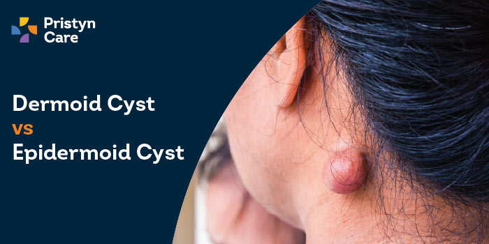 Dermoid Cyst vs Epidermoid Cyst