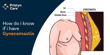 How Do I Know If I Have Gynecomastia?