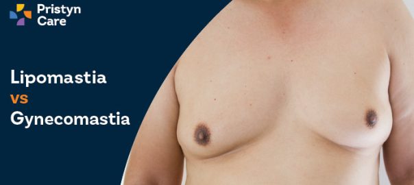 Lipomastia vs Gynaecomastia