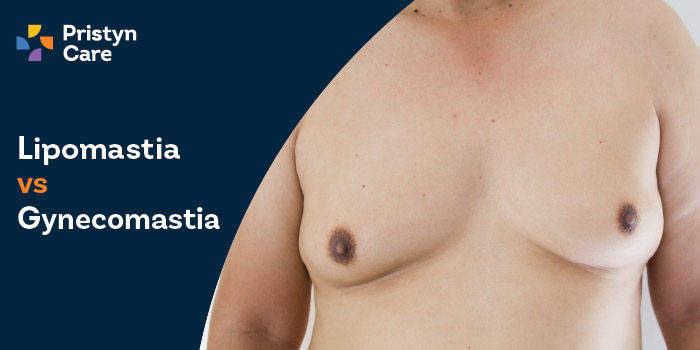 Lipomastia vs Gynaecomastia