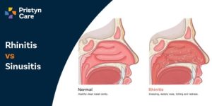 Rhinitis Vs Sinusitis