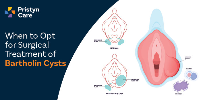 When to Opt for Surgical Treatment of Bartholin Cysts?