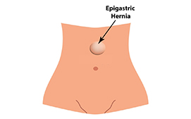 Epigastric hernia